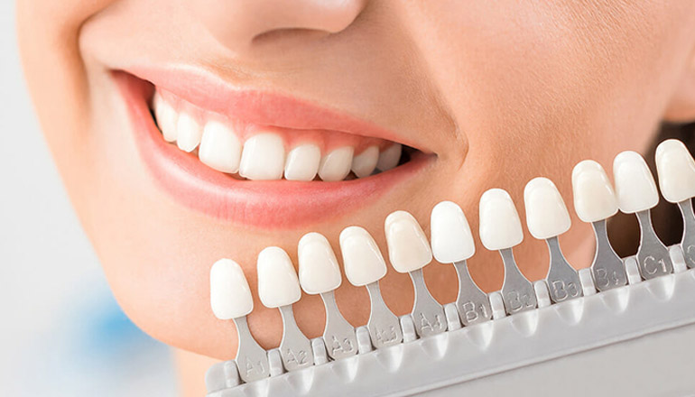 Veneers: Bridging the Gap Between Dental Health and Aesthetic Excellence